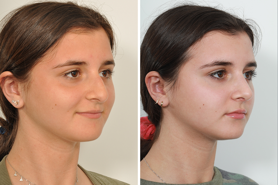 Rhinoplasty, Nose Surgery, Nose Job For Women In New York City 