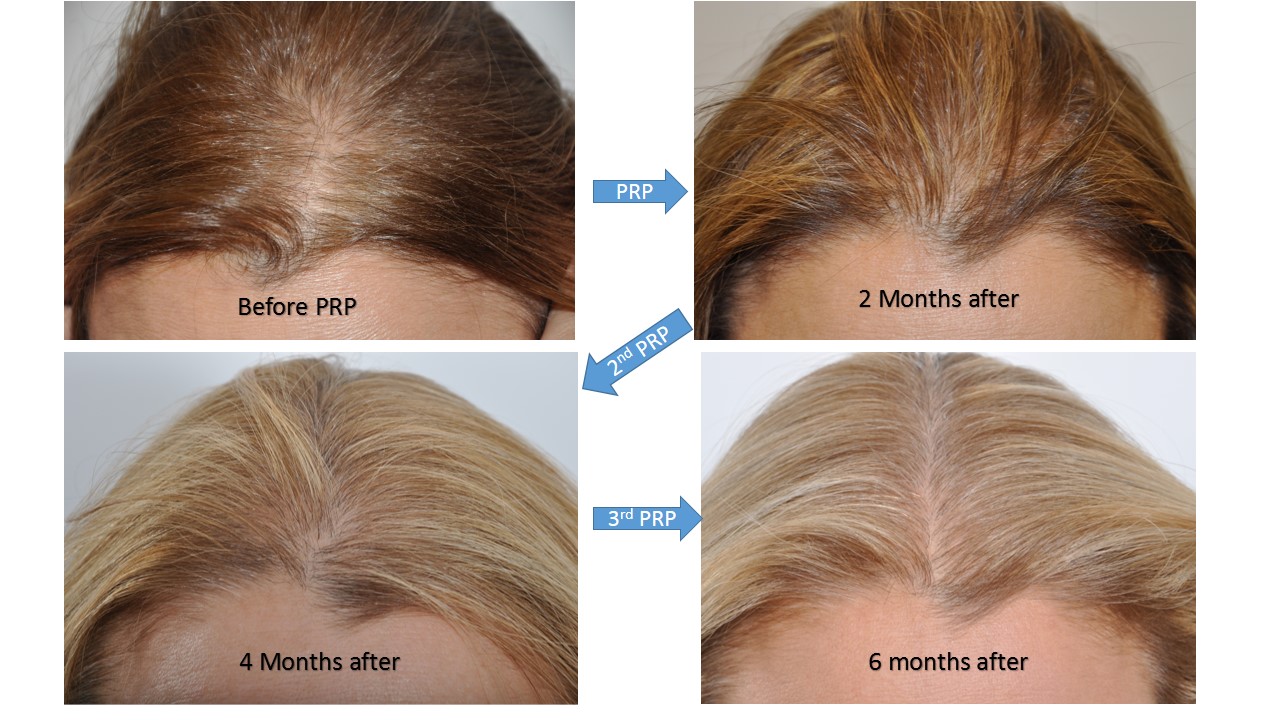 Hair Loss Treatments (Surgical) For Women Dr. David Rosenberg