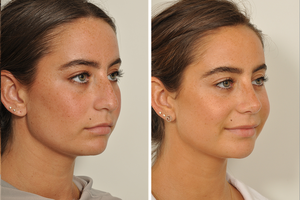 Top Celebrity Rhinoplasty Surgeon, Natural Looking Nose Job Surgery For