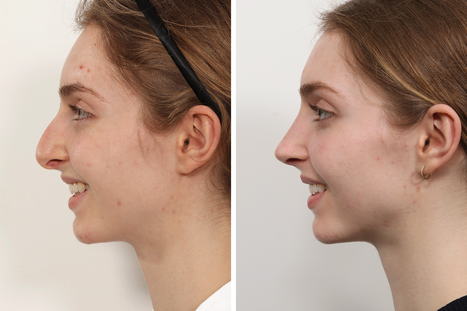 Top Celebrity Rhinoplasty Surgeon, Natural Looking Nose Job Surgery For  Women, Best Revision and Rapid Recovery Rhinoplasty Surgeon In Manhattan,  Upper East Side, New York City, Connecticut, Washington, Boston and New  Jersey.