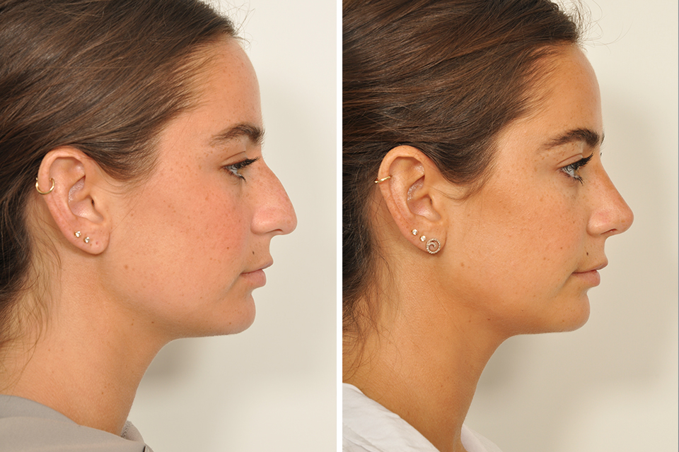 Rhinoplasty-216